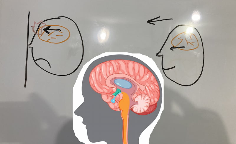 How impacts (sudden stops, i.e. sudden decelleration or accelleration) can cause concussions and brain injuries, even if the skull doesn't break